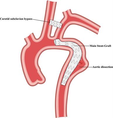 Efficacy of left subclavian artery revascularization strategies during thoracic endovascular aortic repair in patients with type B dissection: A single-center experience of 105 patients